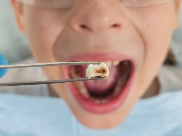 Best Emergency Root Canal Treatment in Narrows, VA